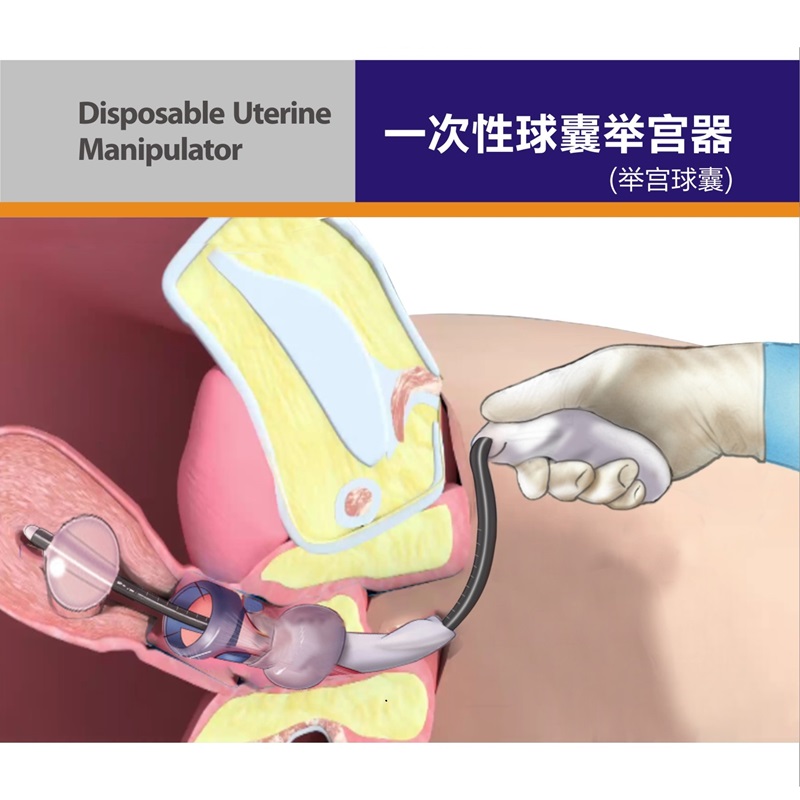 一次性举宫器插图1 一次性举宫器插图1