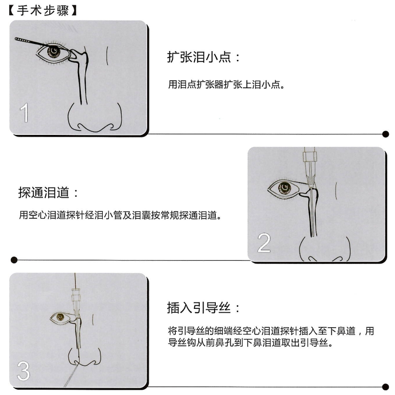 鼻泪管泪道引流管插图1