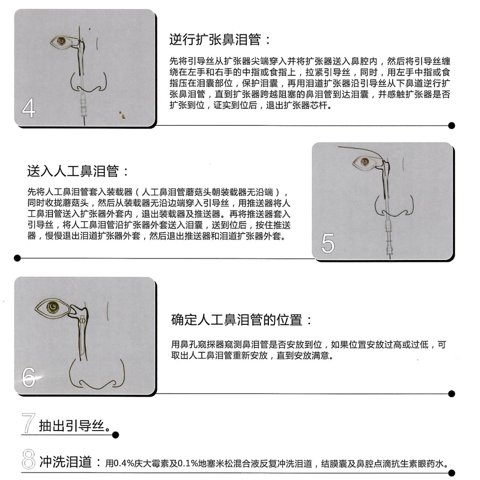 鼻泪管泪道引流管插图2