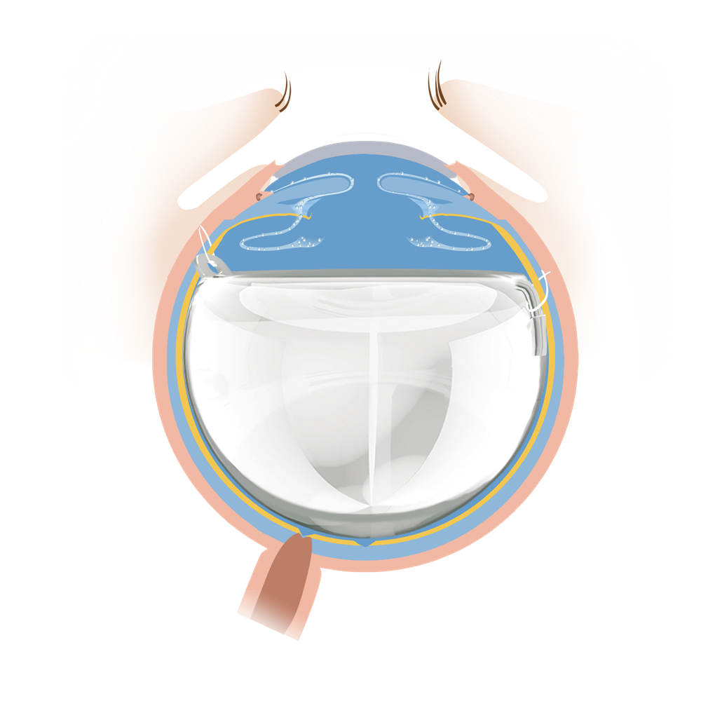 折叠式人工玻璃体球囊(FCVB)插图1