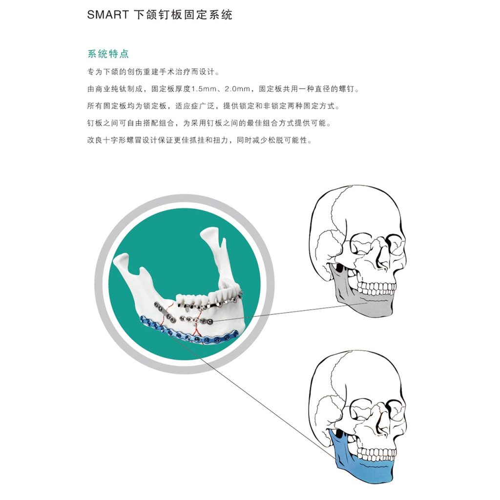 金属颅颌面接骨板插图1 金属颅颌面接骨板插图1